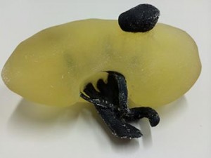 Printed kidney with tumor